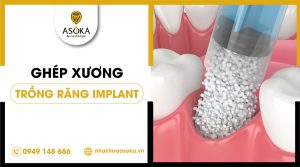 ghep-xuong-cay-ghep-implant-gia-bao-nhieu