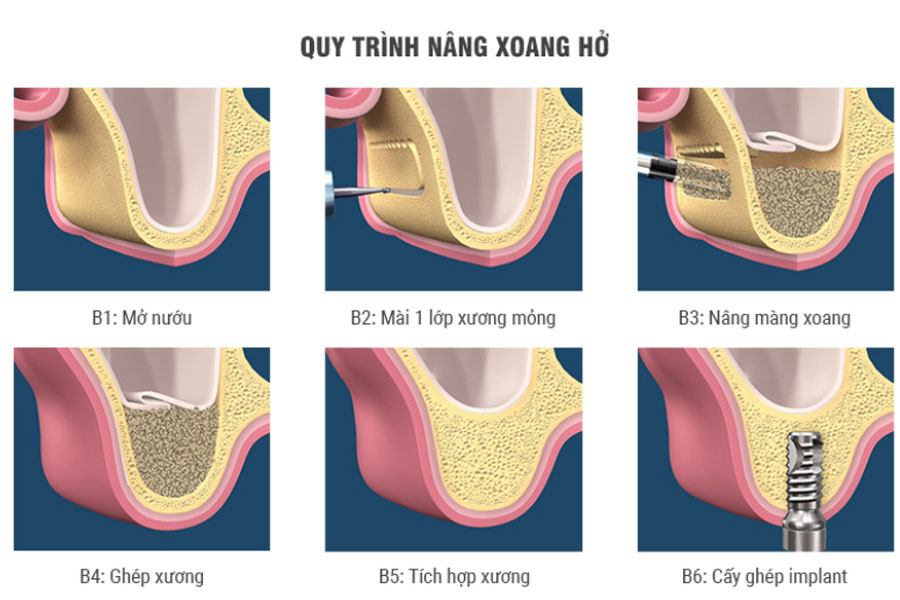 hinh-anh-xoang-cay