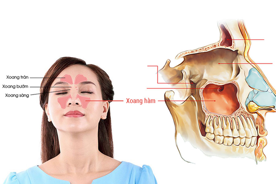 nang-xoang-implant