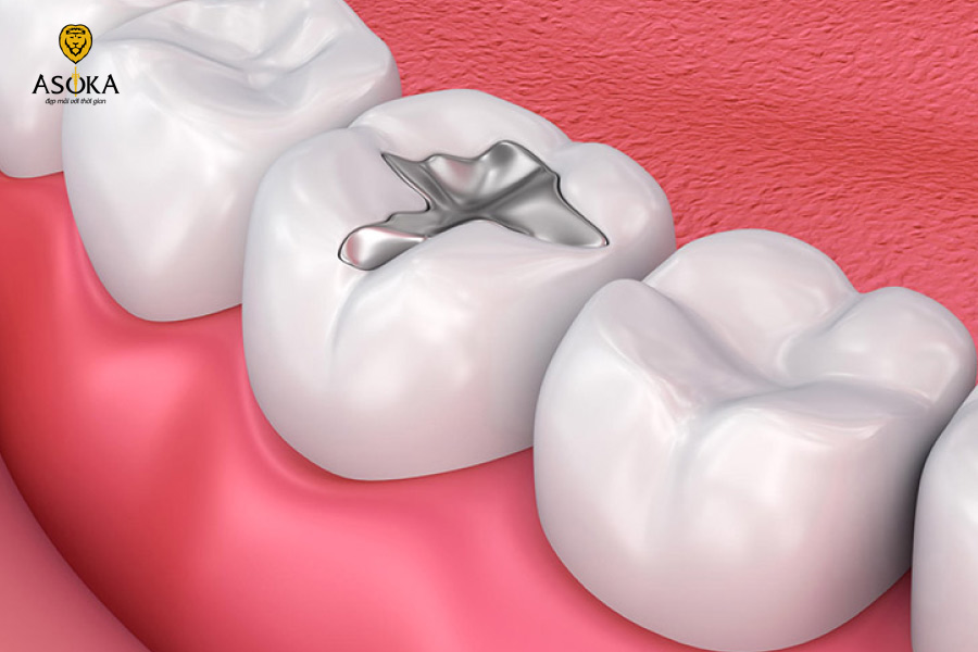 Có nên trám răng bằng Amalgam không?