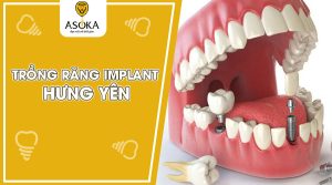 implant-hung-yen