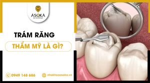 tram-rang-tham-my