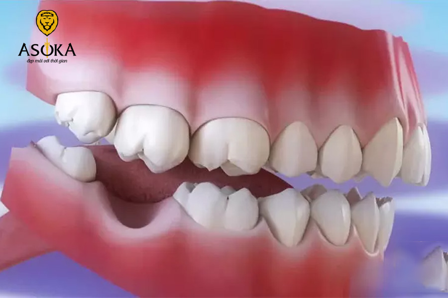 Mất răng do bệnh lý răng miệng