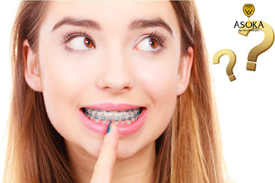 Niềng răng cải thiện chức năng ăn nhai