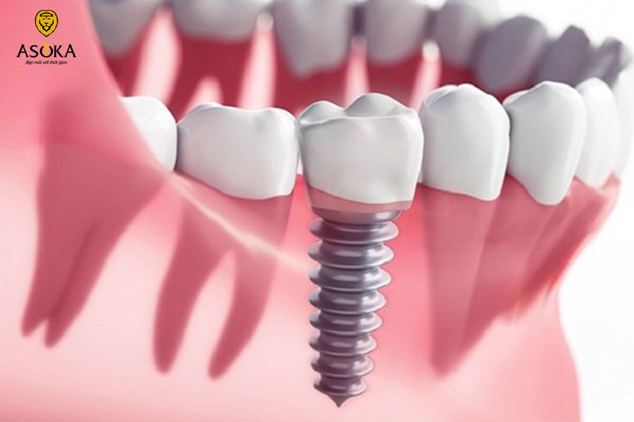 Biến chứng sau trồng răng implant
