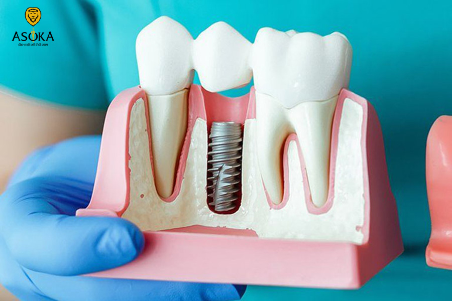 Chi phí khám tổng quát trước trồng răng implant