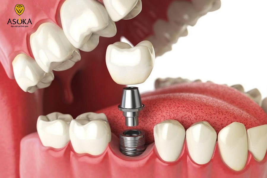Trồng răng implant giá bao nhiêu?