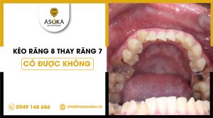 keo-rang-8-thay-rang-7-co-duoc-khong